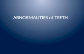 ABNORMALITIES of TEETH. Abnormalities of Teeth Environmental abnormalities of teeth Developmental abnormalities of teeth.
