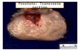 Prostate: Transverse section. Apex Bladder neck Radical Prostatectomy.