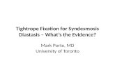 Tightrope Fixation for Syndesmosis Diastasis – What’s the Evidence? Mark Porte, MD University of Toronto.
