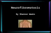 Neurofibromatosis By Shannon Weeks. What is Neurofibromatosis? Neurofibromatosis type I (NF1) is caused by mutation in the neurofibromin gene AKA von.