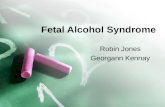 Fetal Alcohol Syndrome Robin Jones Georgann Kennay.