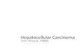 Hepatocellular Carcinoma Amr Khayat, MBBS. Hepatocellular carcinoma (HCC) is a primary malignancy of the liver. It is now the third leading cause of cancer.