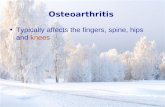 Osteoarthritis Typically affects the fingers, spine, hips and knees.