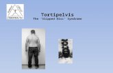 Tortipelvis The ‘Slipped Disc’ Syndrome. Tortipelvis Often called the slipped disc syndrome, this condition is most simply defined as: a tortuous position.