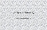 Ectopic Pregnancy By Rohan Kulkarni. Defination. Any pregnancy where the fertilised ovum gets implanted & develops in a site other than normal uterine.