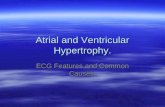 Atrial and Ventricular Hypertrophy. ECG Features and Common Causes.