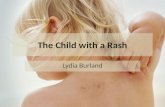 The Child with a Rash Lydia Burland. Learning Outcomes By the end of the session students should;  Be able to recognise common rashes presenting in childhood.