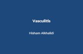 Vasculitis Hisham Alkhalidi. Vasculitis Vascular inflammatory injury, often with necrosis.