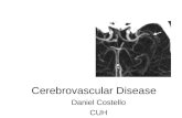 Cerebrovascular Disease Daniel Costello CUH. Cerebral Vasculature Arterial system Venous system.