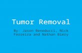 Tumor Removal By: Jason Beneducci, Nick Ferreira and Nathan Biery.