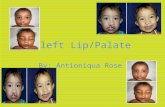 Cleft Lip/Palate By: Antioniqua Rose. What Causes Cleft Lip ? Cleft lip and also cleft palate occurs when tissues in the baby’s face and mouth don’t form.