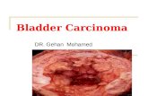 Bladder Carcinoma DR. Gehan Mohamed. Bladder Carcinoma Definition: malignant tumor arising from the epithelial lining of the urinary bladder. (N.B normal.