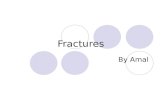 Fractures By Amal. Types of fractures: Complete fractures  The bone is completely broken into two or more fragments.