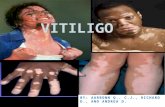 BY: AARRONN Q., C.J., RICHARD D., AND ANDREA D.. What is Vitiligo? Vitiligo is a disorder that causes the skin to have white patches in various places.