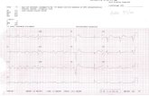 Alternating bundle branch block  Alternating bundle branch block is diagnosed when conducted periods of RBBB and LBBB were noted in a patient on the.