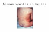 German Measles (Rubella). German Measles Virus Icosahedral shape Contains RNA.