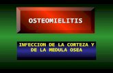 INFECCION DE LA CORTEZA Y DE LA MEDULA OSEA OSTEOMIELITIS.