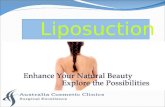 Liposuction – A Procedure/Treatment to get Rid of Extra Fat