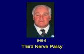 Third Nerve Palsy