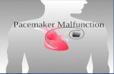 Pacemaker Malfunction