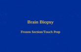 Brain Biopsy