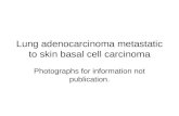 Lung adenocarcinoma metastatic to skin basal cell carcinoma