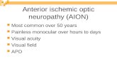Anterior ischemic optic neuropathy (AION)