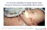 A 9-month-old Baby in Septic Shock with Purpuric  Neisseria meningitidis  Skin Lesions