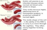 Sickle cell anemia is an inherited disease where normal red blood cells  sickle in shape.