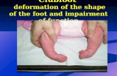 Clubfoot  deformation of the shape of the foot and impairment of function