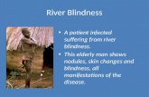 River Blindness
