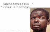 Onchocerciasis “River Blindness”