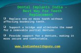 Why Dental implants in India is Beneficial?
