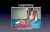Leprosy Kristopher Brevard 1. What is leprosy? Ancient disease Causes skin sores, nerve damage and muscle weakness Worsens with time 2.
