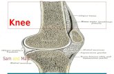 Knee Sam and Matt. Disease: Osteoarthritis Knee with Osteoarthritis.