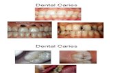 Proses Caries