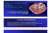 01 Dadang How to Detect and Treat ATrial Fibrilasi_dr. Dadang (1) - Copy