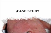 case study neonatal sepsis.doc