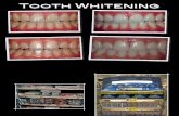02 01 11 - Tooth Whitening