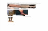 The clinical finding of varicose veins