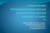 Failed dental bridge replaced with dental implants in india