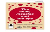 The child, measles and the eye