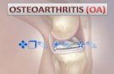 Osteoarthritis pathophysiology & updated management