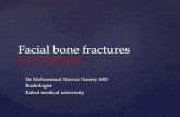 Facial bone fracture