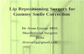 Lip repositioning surgery for Gummy Smile Correction