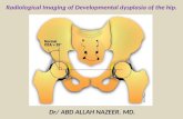 Presentation1, radiological imaging of developmental dysplasia of the hip joint.