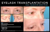Eyelash transplant live-patient-viewing_ISHRS-2015 - Dr Alan Bauman