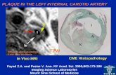081 carotid artery plaque