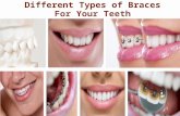 Different Types of Braces For Your Teeth