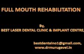FULL MOUTH REHABILITATION WITH IMMEADIATE LOADING BASAL IMPLANTS